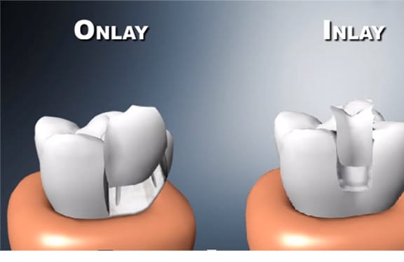 Inlays and Onlays
